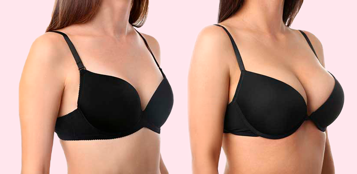 mamoplastia de aumento