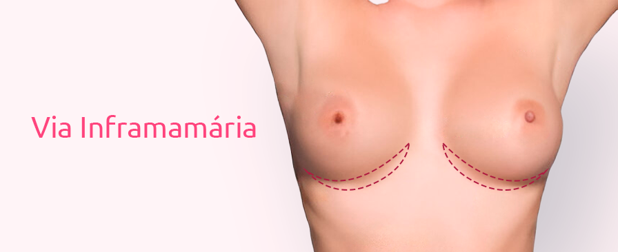 Tudo sobre Prótese de Silicone: Valores, Modelos e Mais 9 Silicone Via Inframamária
