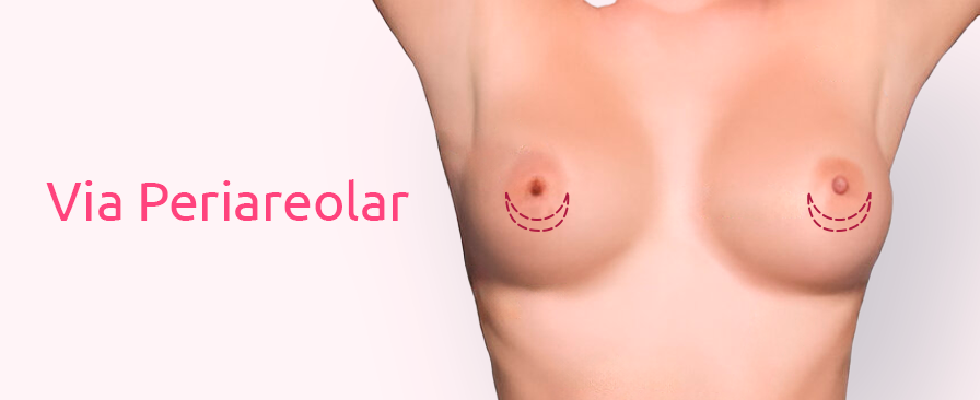 Tudo sobre Prótese de Silicone: Valores, Modelos e Mais 8 Silicone Via Periareolar