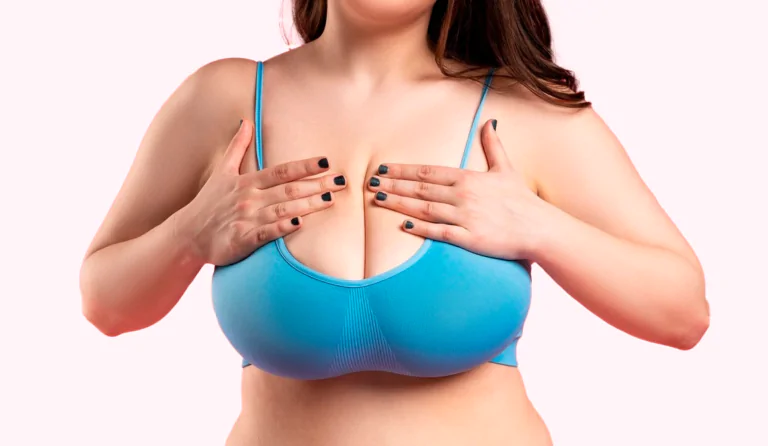 mamoplastia redutora
