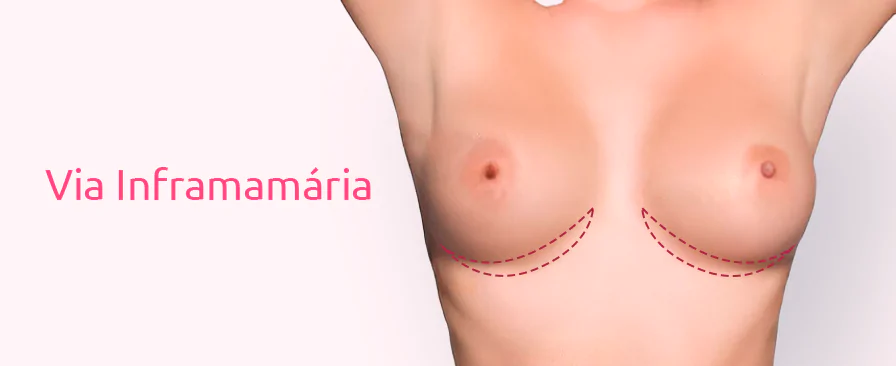 Tudo sobre Prótese de Silicone: Valores, Modelos e Mais 8 Silicone Via Inframamária