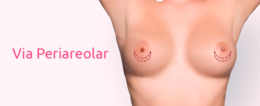 Tudo sobre Prótese de Silicone: Valores, Modelos e Mais 7 Silicone Via Periareolar