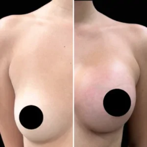 Colocar silicone em Campinas-SP 9 antes e depois silicone