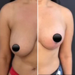 Colocar silicone em Campinas-SP 7 antes e depois silicone