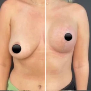 Colocar silicone em Campinas-SP 8 antes e depois silicone