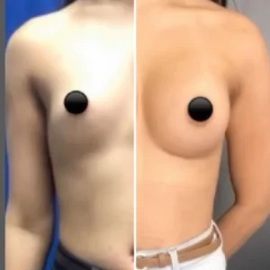 Colocar silicone em Campinas-SP 10 antes e depois silicone